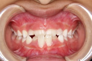 中切歯が逆被蓋で、下の中切歯は歯肉退縮が起こり始めています
